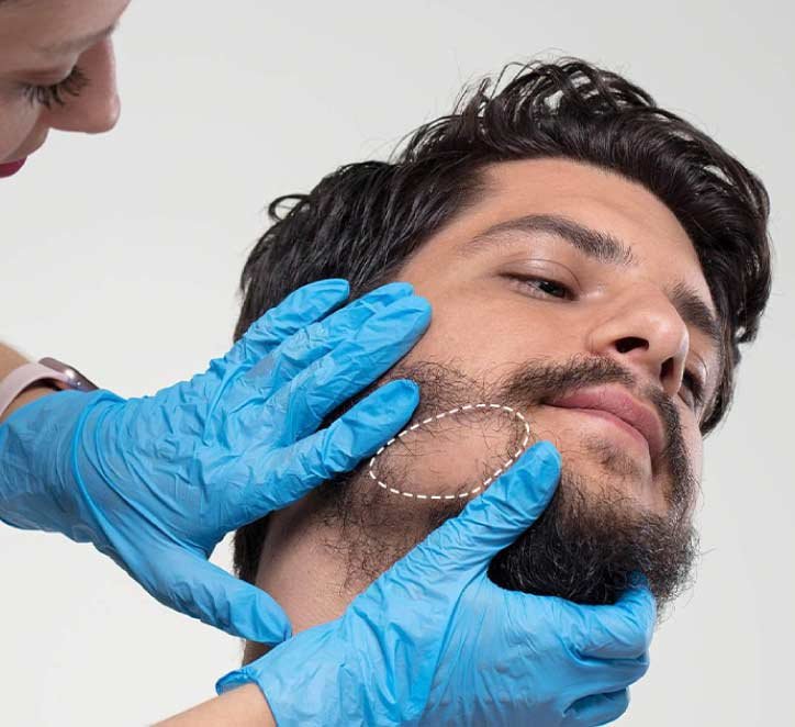 Beard Transplant at Aestanbul