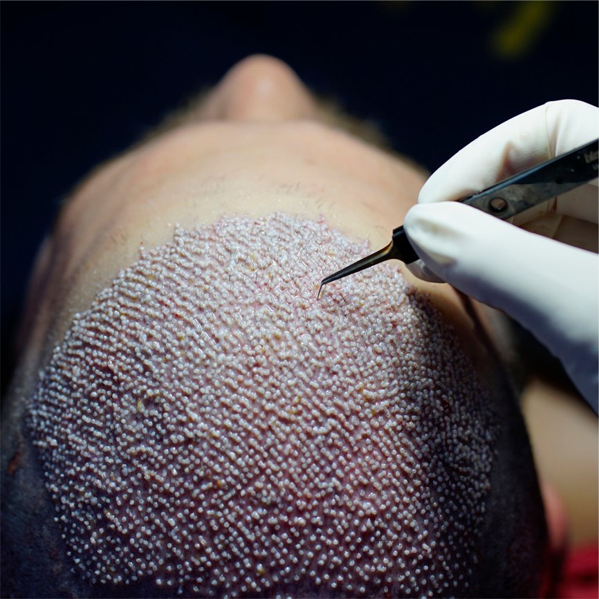 Sapphire Hair Transplant at Aestanbul