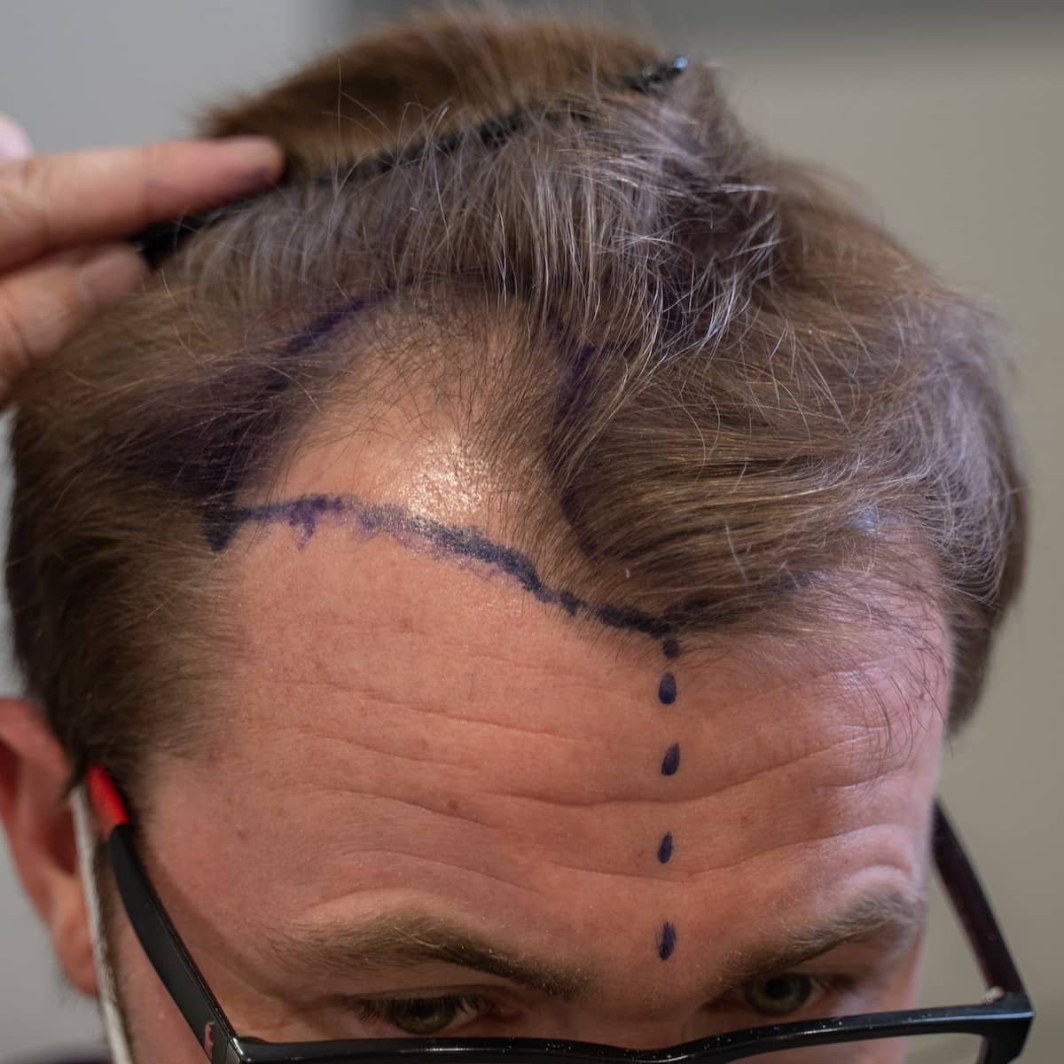 DHI Hair Transplant at Aestanbul