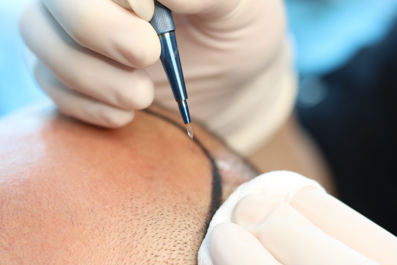 FUE Hair Transplant at Aestanbul