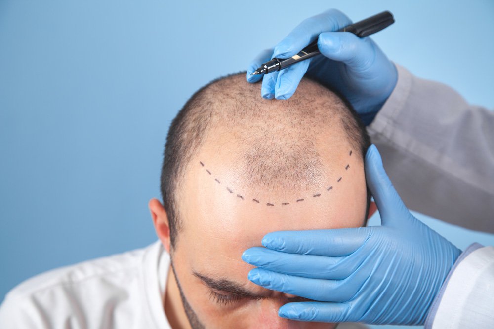 Hair Transplant at Aestanbul
